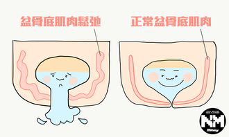 盆底肌损伤后没有症状可以不治疗吗