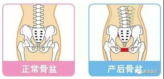 产后康复仪器能对骨盆产生康复巩固作用吗？答案肯定是可以的