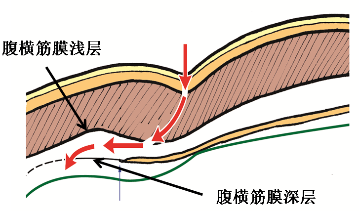 腹直肌修复