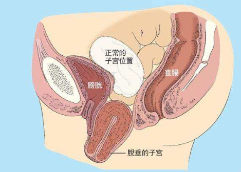 盆底修复治疗