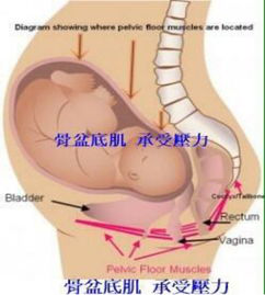 盆底康复治疗