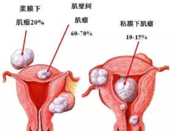 盆底肌修复