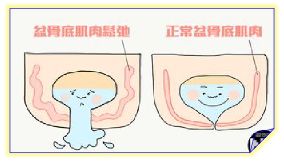 产后盆底康复