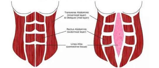 腹直肌分离