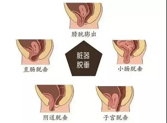 脏器脱垂2.JPG