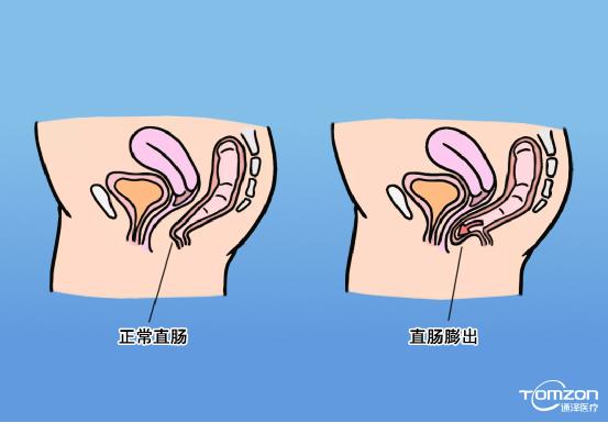 盆底肌修复仪器